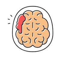 7. Tai biến mạch máu não – di chứng sau đột quỵ